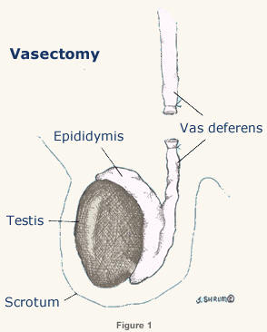 O mobile sperm after vasectomy reversal